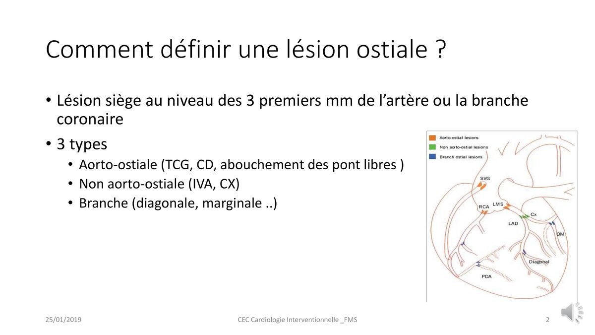 Schéma de l'arbre coronaire où trois couleurs distinguent les lésions aorto-ostiales, non aorto-ostiales et les ostiums de branche.