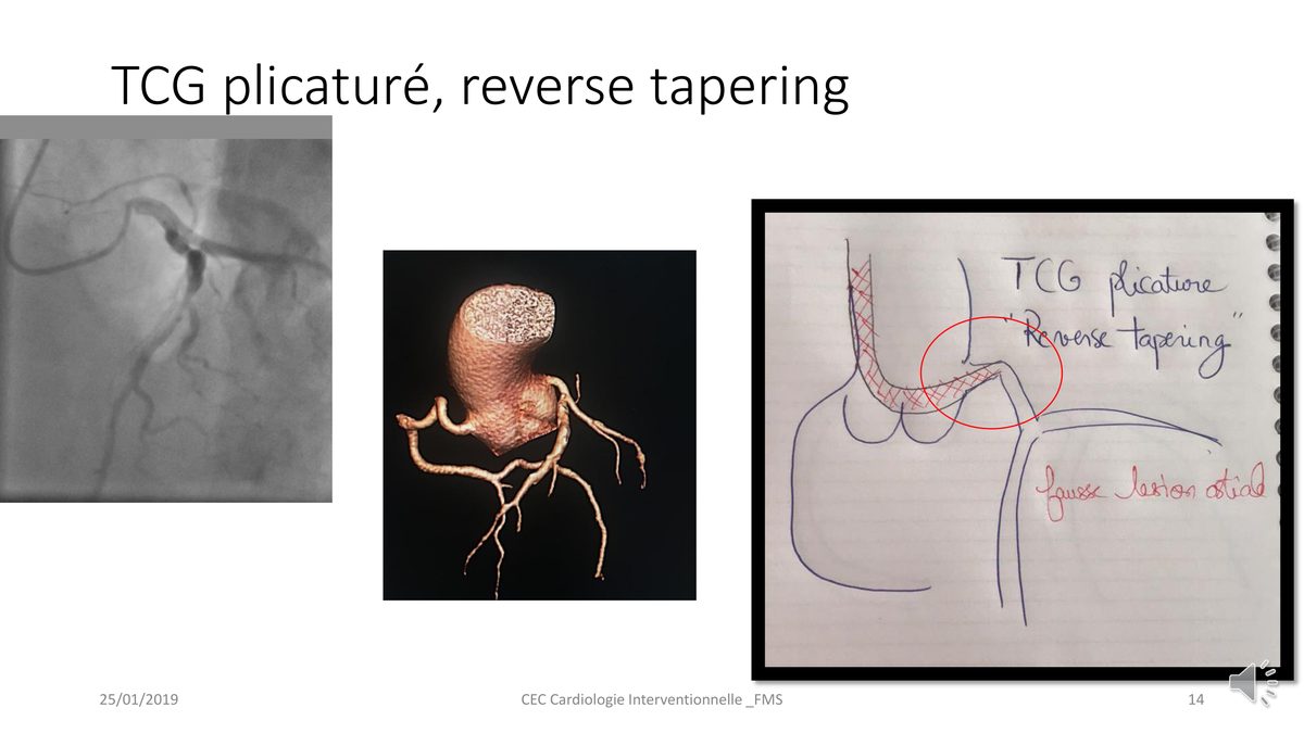 Angiographie, reconstruction tridimensionnelle et schéma manuscrit illustrant un tronc commun plicaturé simulant une sténose ostiale.