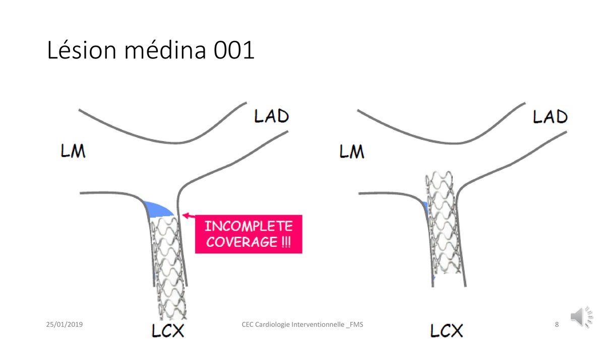 Deux schémas de bifurcation comparant un stent qui laisse l'ostium découvert à un stent qui le couvre entièrement.