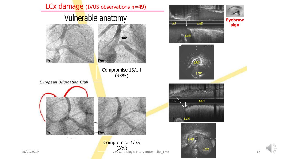 Comparaison angiographique et échographique de deux bifurcations, l'une à carène en pointe et l'autre émoussée, avec le devenir de la circonflexe dans chaque cas.