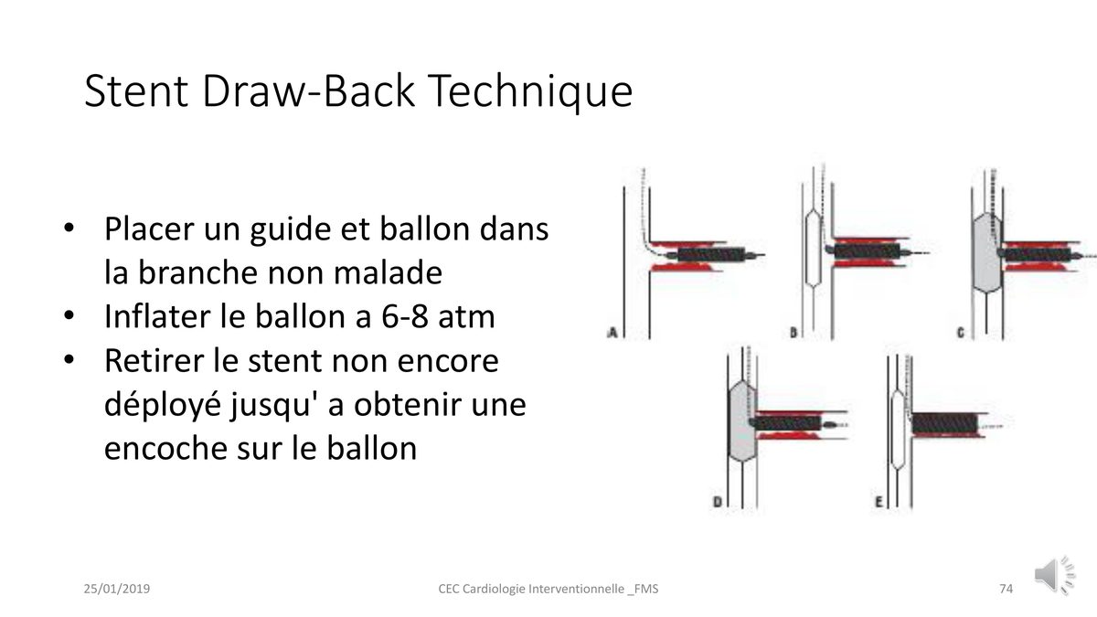 Schéma en cinq temps de la technique du retrait du stent contre un ballon gonflé dans la branche voisine.