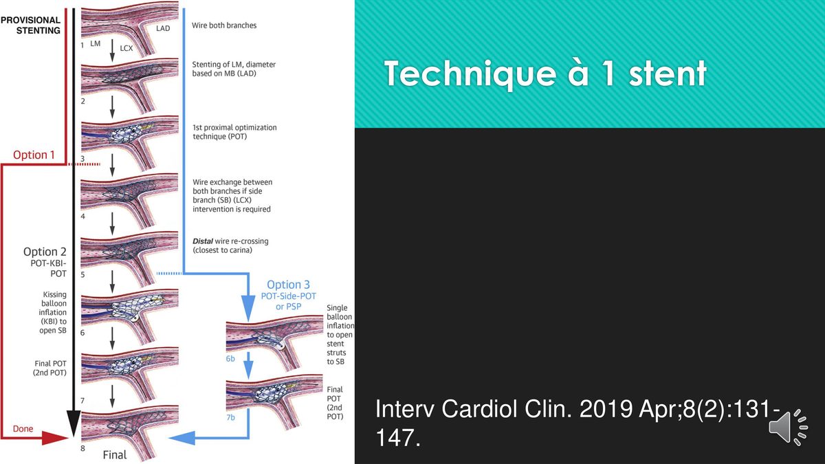 Algorithme en huit temps du stenting provisionnel d'une bifurcation, avec ses trois issues possibles.