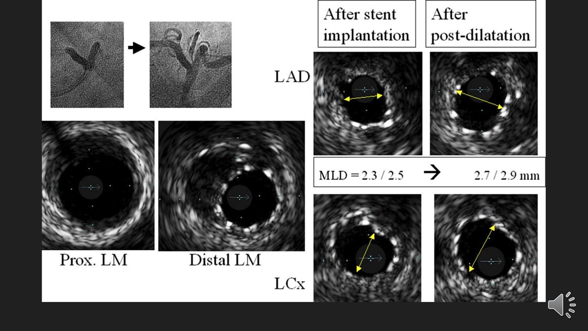 Coupes d'échographie endocoronaire du tronc commun et de ses deux branches, avant et après postdilatation, avec les diamètres luminaux minimaux.
